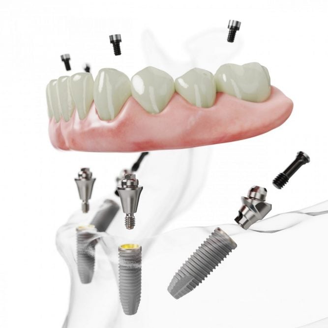 parts for dental implants and all-on-4 treatment concept