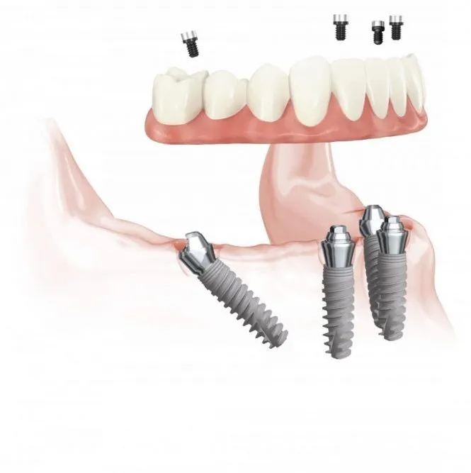 beginning stage of all-on-four treatment concept, replacing missing teeth