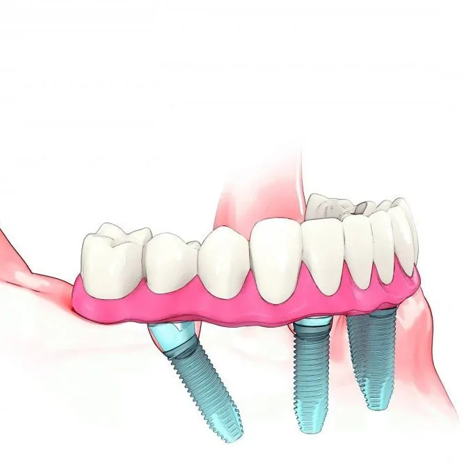 finished stage of all-on-four treatment concept, missing teeth replacement